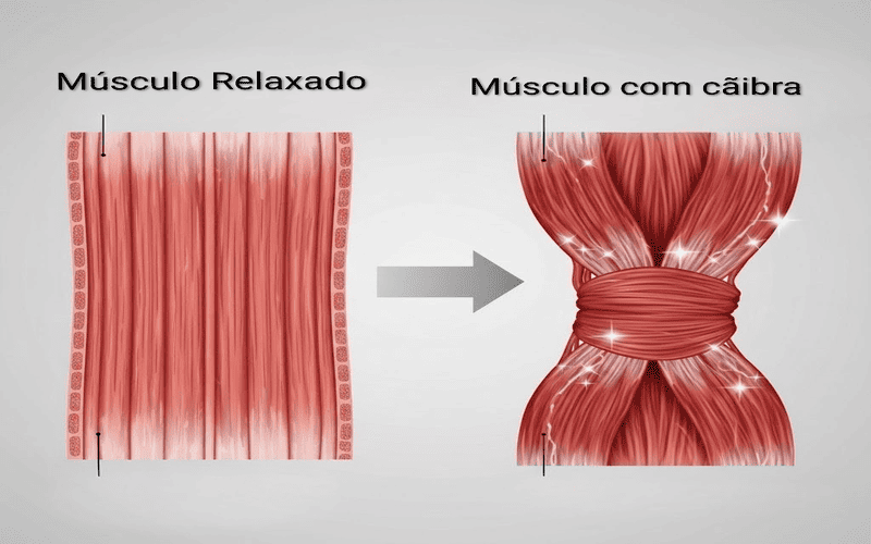 Comparação entre músculo normal e músculo em cãibra